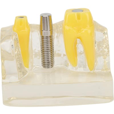 Modèle d'implant dentaire transparent, enseignement dentaire, recherche, démonstration, modèle de dents yellow
