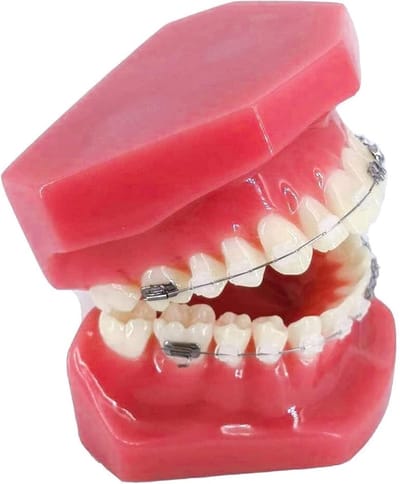 Tandheelkundig Model - Ortho Demonstratie - Tandarts Communicatie - Met Beugels - Niet Van Toepassing - Niet Van Toepassing