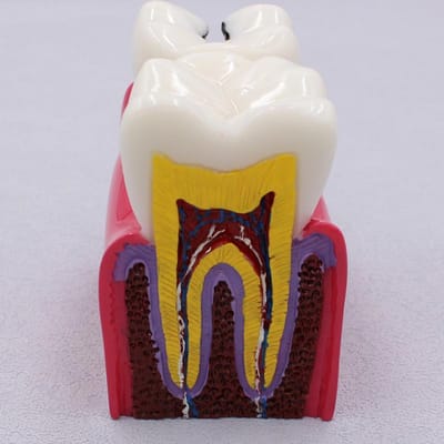 Nieuwste 6 keer Cariës Vergelijking Model Ziekte Tanden Perfect Voor Tandheelkundige Demonstratie Student Tandheelkunde Studeren Anatomie Onderwijs Onderzoek yellow