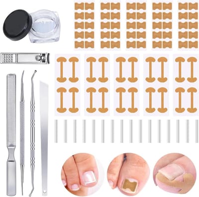 Set voor het corrigeren van ingegroeide teennagels - Pijnvrije oplossing met C-vormige vulling voor gezonde nagels en comfort
