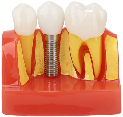 Allecto - Dental Implant Model - Professionele Training - Hoogwaardige Kwaliteit - Realistisch - Educatie - Medische Training - Geschikt voor Tanda...