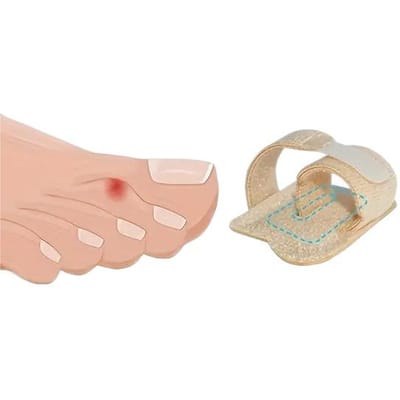 Nieuwe teenspalk voor valgus teen, overlappende ondersteuning, bevestigingsband, teenverzorgingsbrace one average size