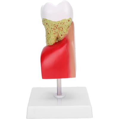 Tandcariës Tandmodel Dental Tandenmodel voor Onderwijs Training Patiënteneducatie