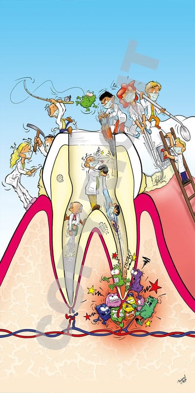 Cartoon plafondplaat - Poster - Roland Hols - Doorsnede kies - 60 x 120 cm - Forex 10 mm dik - Tandarts - Orthodontist -Mondhygiënist - voor boven de behandelstoel