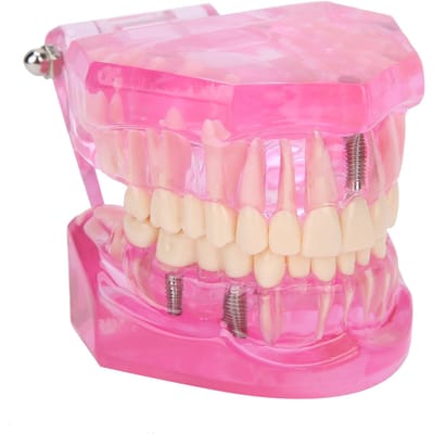 Transparant Volwassen Tanden Model Pathologische Reparatie Studeren Tandheelkundige Lesmaterialen pink