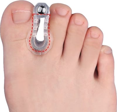 Hiden - Teenspreider - Teenspreider Siliconen - Teen corrector - Teenspreider voor alle tenen - Hamer teen