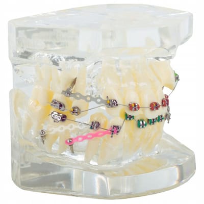 Hangzhou A Link Star Technology Co. Limited - Model Stomatologisch - Realistische Replika - Orthodontisch Apparaat - Educatief