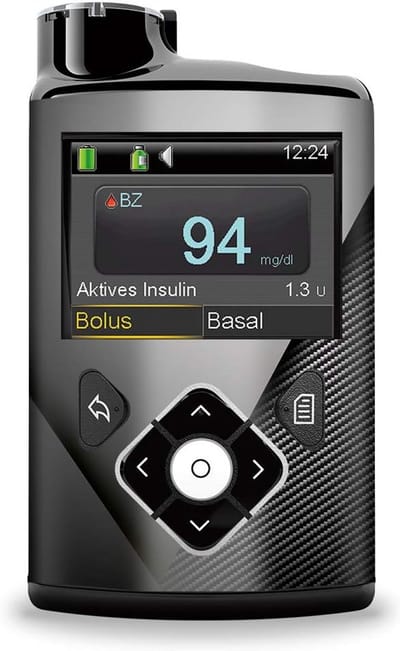 Decoratieve Sticker Carbon voor Insulinepomp Besturingsapparatuur - Perfecte Pasvorm