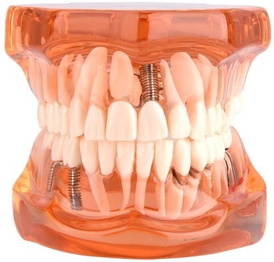 OmGoods - Dailygoody - Tandarts Verwijderbare Standaard - Tandheelkundige Tools - Ideaal voor Demonstraties - Oranje Kleur - Implantatiemodel - Geschikt vo