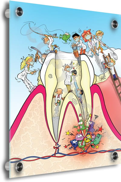 Tandarts Cartoon op plexiglas - Uniek ontwerp - Roland Hols - Doorsnede kies - 30 x 40 cm - 5 mm dik - inclusief 4 afstandhouders chroom (zilverkleurig) - Decoratie - Orthodontist - Mondhygiënist