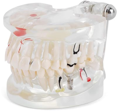 Dailygoods - Dental Implant Study Model - Volwassen Tandmodel - Realistisch Onderwijsmodel - Transparant - Verwijderbare Tanden - Ideaal voor Tandheel...