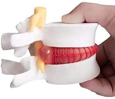 Wervelkolom Model - Anatomisch Model - Onderwijs Demonstratie - Pathologische Presentatie - 5-Wervel Segment - Multicolor