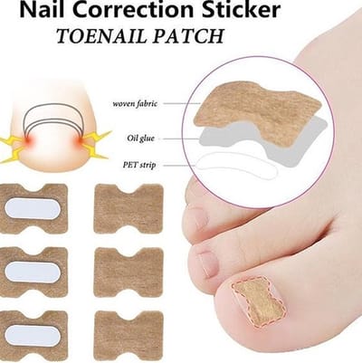 Teennagel Lifter – Ingegroeide Teennagel Corrector – 30 Teennagel Pleisters – Anti Ingroei Pleister – Nagel Correctie Kit – Pijnverlichtend & Eenvoudig in Gebruik