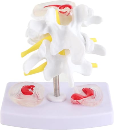 Lumbale Disc Hernia Demonstratie Model - Anatomische Human Spine - School Trainingsbenodigdheden voor Studenten - Leraren - Artsen