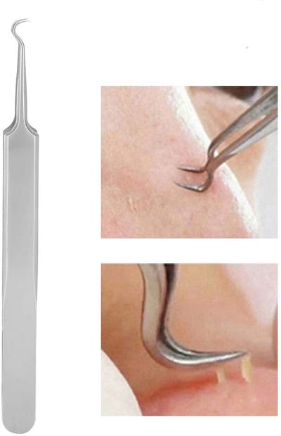Allecto - Blackhead Remover - Pimple Verwijderaar - Precisie Klem - Zwart - Acne Verzorging - Comedonen Verwijderen - Geschikt voor Alle Huidtypes
