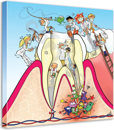 Tandarts Cartoon op canvas - Roland Hols - Doorsnede kies - 60 x 60 cm - Houten frame 4 cm dik - Orthodontist - Mondhygiënist