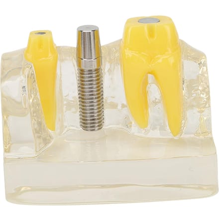 Modèle d'implant dentaire transparent, enseignement dentaire, recherche, démonstration, modèle de dents yellow