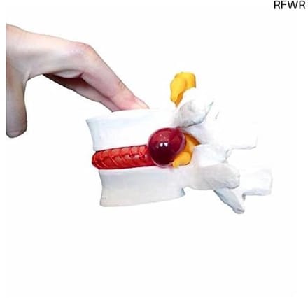 RFWR® Interactief Menselijk Anatomie Model voor Hernia - Ideaal voor Artsen en Studenten