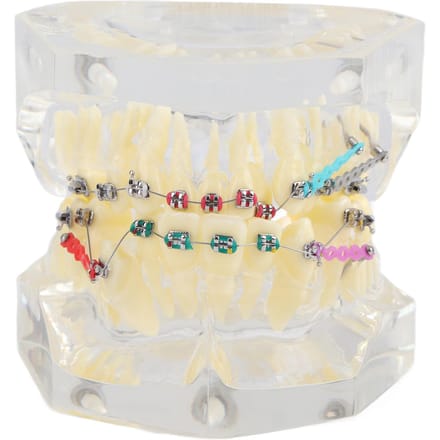 Tandheelkundige Orthodontische Behandeling Malocclusie Studie Tandenmodel Met Draadketting beige