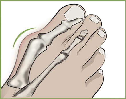 Hallux Valgus Teen Spreider