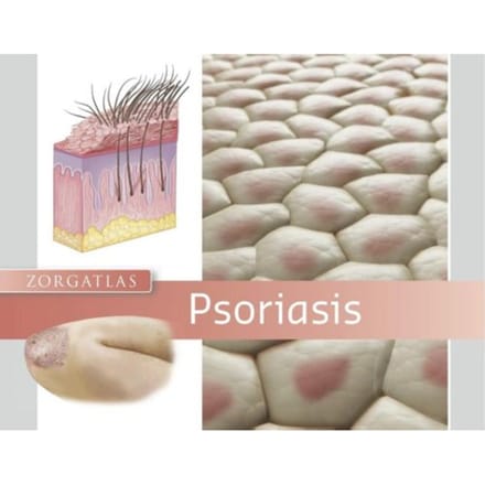 Psoriasis - Zorgatlas - R.C. Beljaards