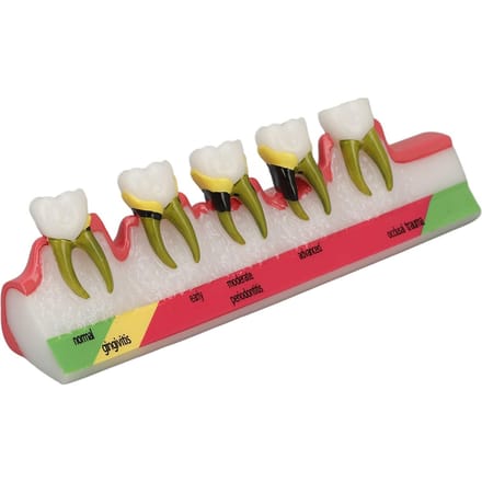 Tanden Parodontale Aandoening Model Verschillende Stadia Hars Tandheelkundig Parodontitis Display Model red