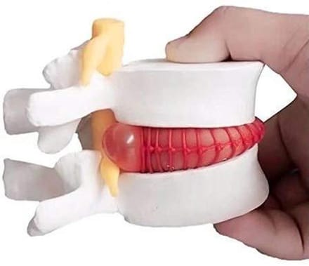 Wervelkolom Model - Anatomisch Model - Onderwijs Demonstratie - Pathologische Presentatie - 5-Wervel Segment - Multicolor