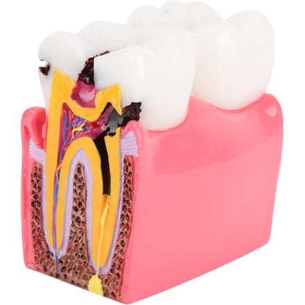 Modèles d'étude de comparaison de caries Dentiste Éducation Anatomie Dentaire Modèle de Dents blanc