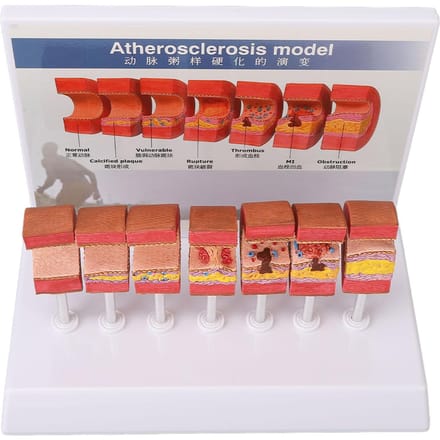 7 STUKS Arterie Anatomie Model Anatomisch Bloedvat Aderverkalking Trombus Vasculair Model voor Artsen brown