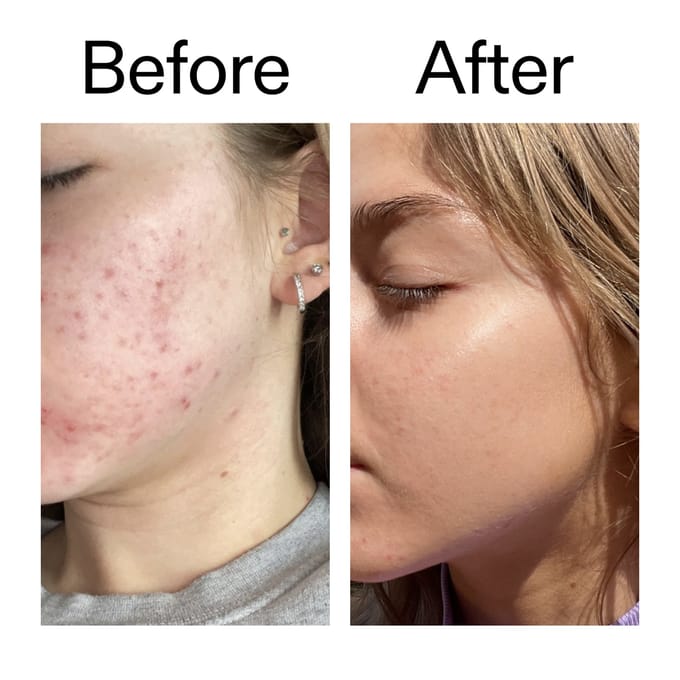 The INKEY List Beta Hydroxy Acid Serum 30 ml