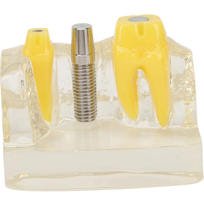 Modèle d'implant dentaire transparent, enseignement dentaire, recherche, démonstration, modèle de dents yellow
