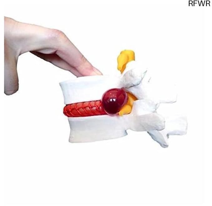 RFWR® Interactief Menselijk Anatomie Model voor Hernia - Ideaal voor Artsen en Studenten