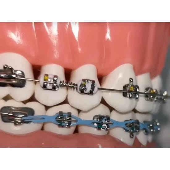 Ressorts Orthodontiques OrthoMetric Flexy NiTi gray