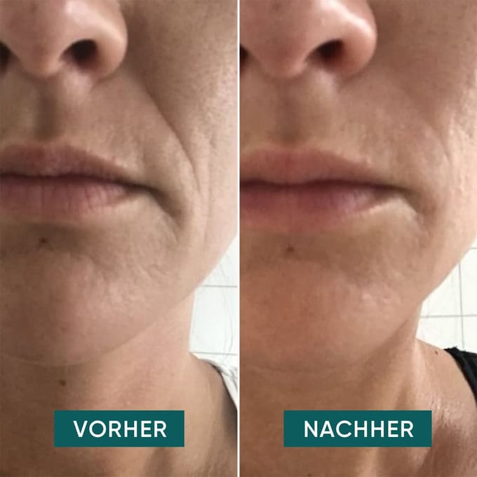 APRICOT Mond-pads met Hyaluron voor rimpelvermindering - 30 behandelingen 2 Pads