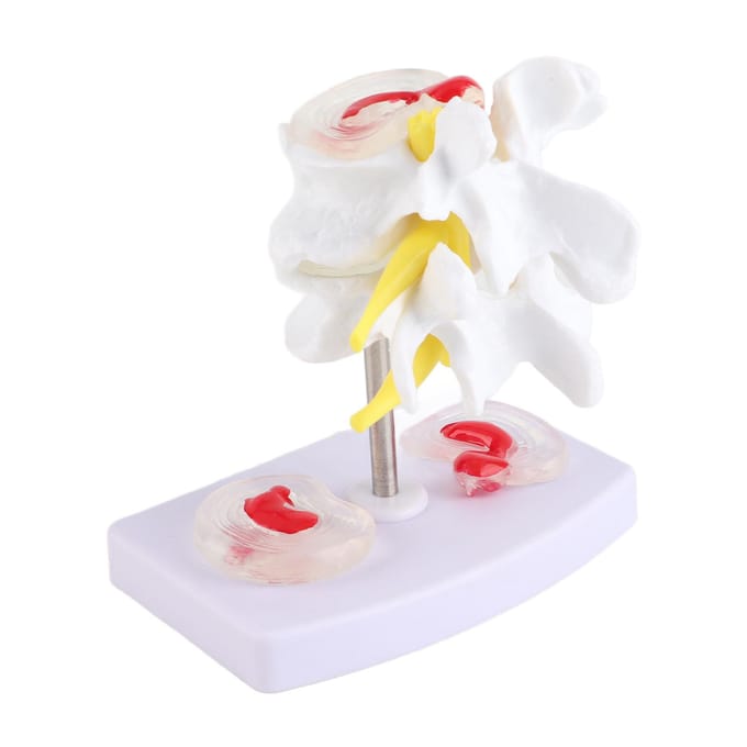 Anatomisch Lendenwervelschijf Hernia Demonstratiemodel Menselijke Wervelkolom School Trainingsmateriaal white