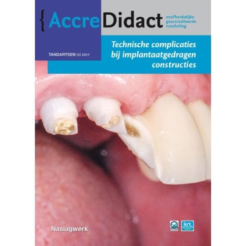 Technische Complicaties Bij Implantaatgedragen Constructies - Accredidact - Gordon van der Avoort