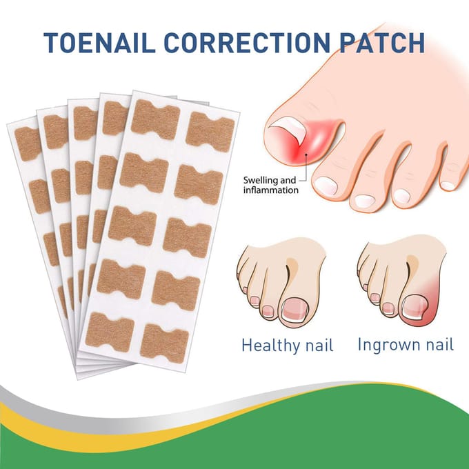 Autocollant pour ongles incarnés, Kit d'outils de Correction des ongles, traitement des ongles des pieds, 50 pièces/boîte jaune