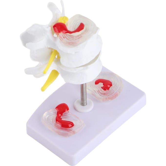 Anatomisch Lendenwervelschijf Hernia Demonstratiemodel Menselijke Wervelkolom School Trainingsmateriaal white