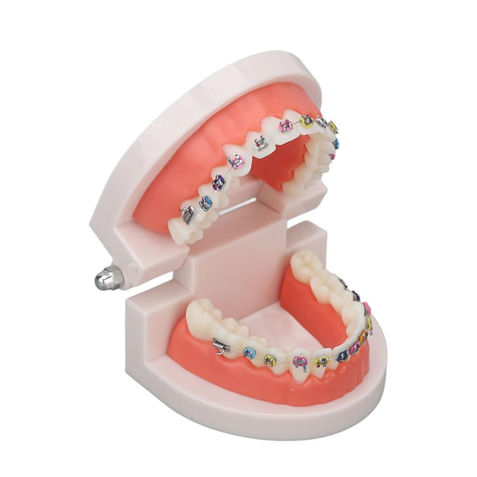 Modèle de dents typodont dentaire avec bracket métallique orthodontique pour enseignement et recherche dentaire white