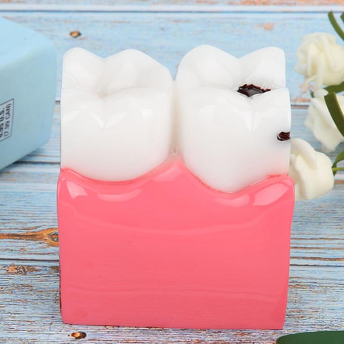 Modèles d'étude de comparaison de caries Dentiste Éducation Anatomie Dentaire Modèle de Dents blanc