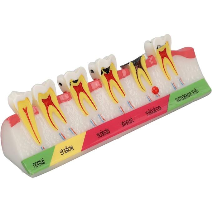 Model Tandbederf 6 Verschillende Stadia Hars Verrotte Tand Displaymodel white