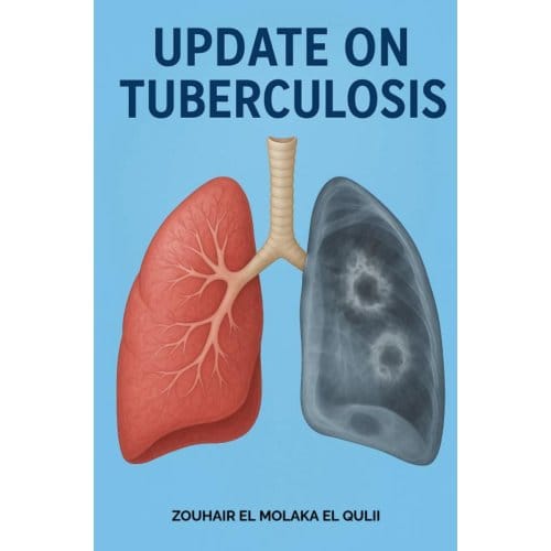 Update On Tuberculosis - Zouhair El Molaka El Qulii