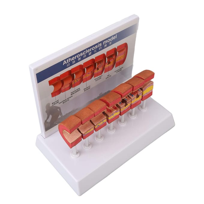 7 STUKS Arterie Anatomie Model Anatomisch Bloedvat Aderverkalking Trombus Vasculair Model voor Artsen brown