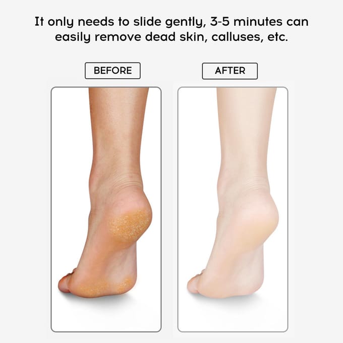 Pied Meuleuse Pédicure Outils De Soins Des Pieds De Callus Remover pour Mort Dur Craquelé Peau Sèche bleu