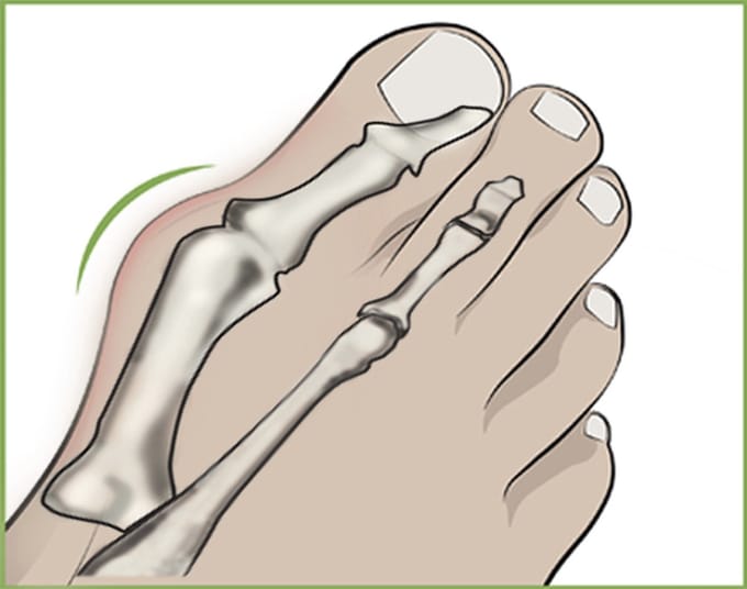 Hallux Valgus Teen Spreider