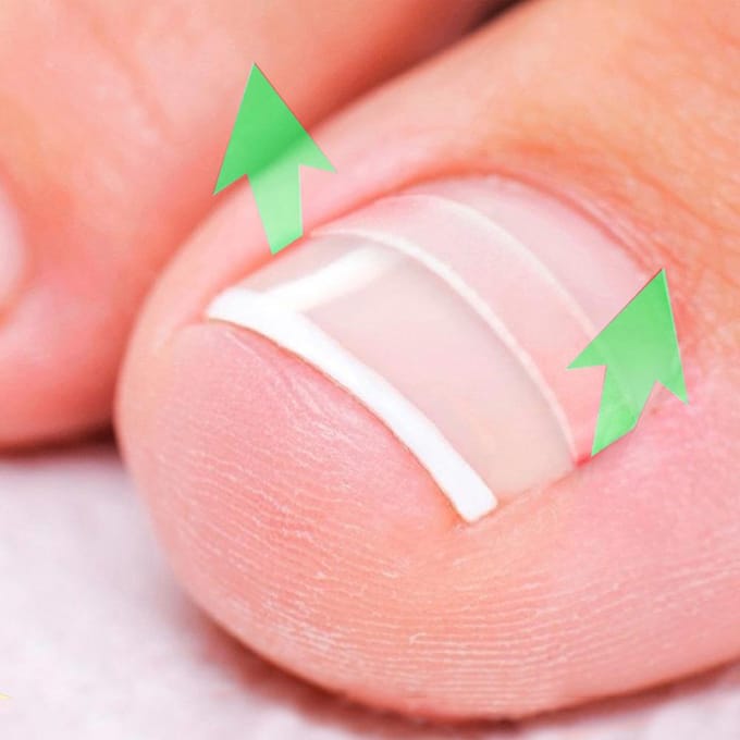 Teennagelcorrectieset Teennagelbehandeling Teennagel rechttrekken Patch Lifter Fixer Recover 01(12pcs) white