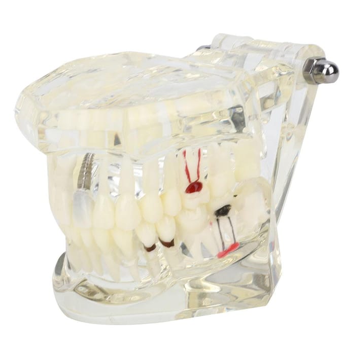 Transparant Ziekte Tanden Model laboratorium Pathologische Anatomie Studie Onderwijs Tand Model white