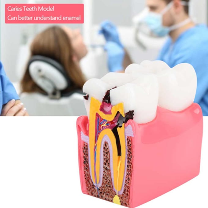 Modèles d'étude de comparaison de caries Dentiste Éducation Anatomie Dentaire Modèle de Dents blanc