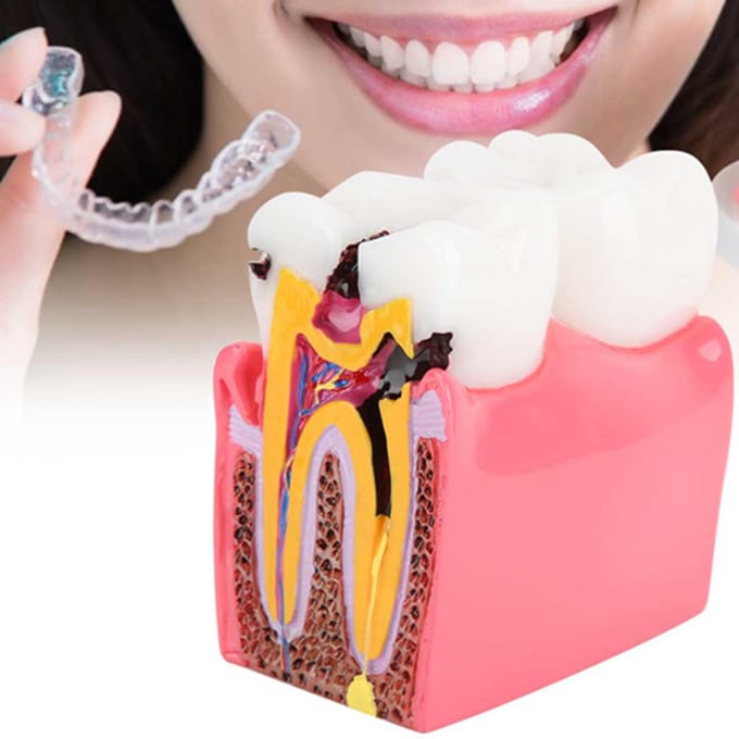 Modèles d'étude de comparaison de caries Dentiste Éducation Anatomie Dentaire Modèle de Dents blanc