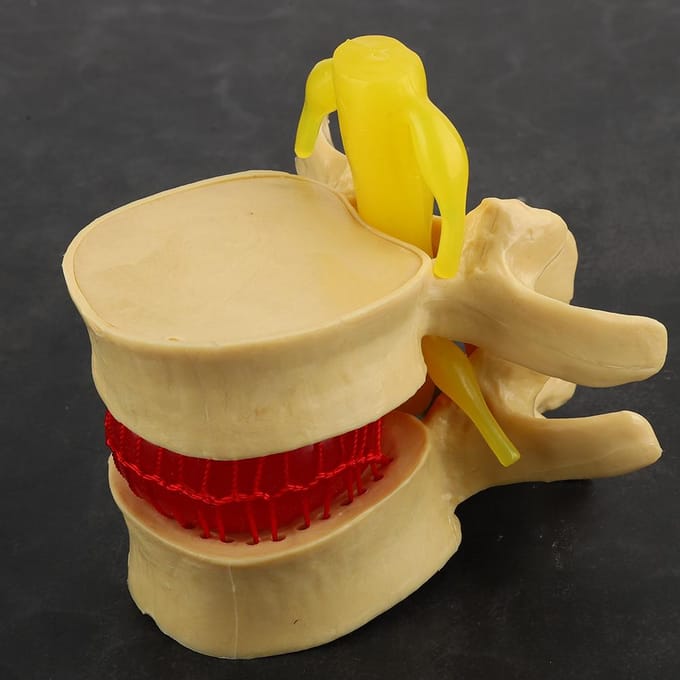 1:1.5 Lendenwervelschijf Hernia Demonstratiemodel Studie Leer Menselijke Wervelkolom beige